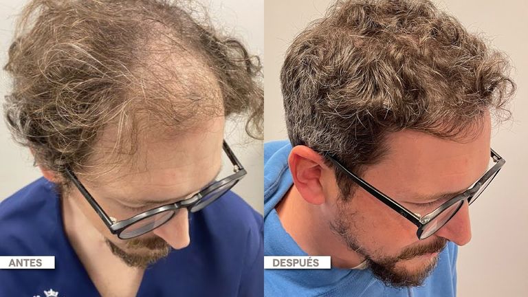 Hair Recovery