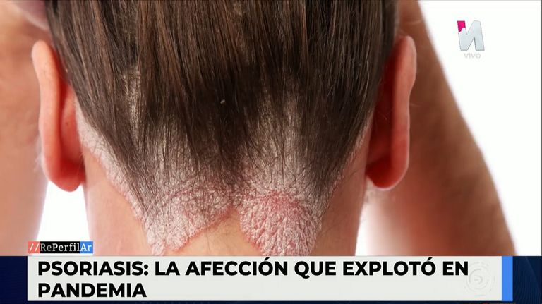 Psoriasis