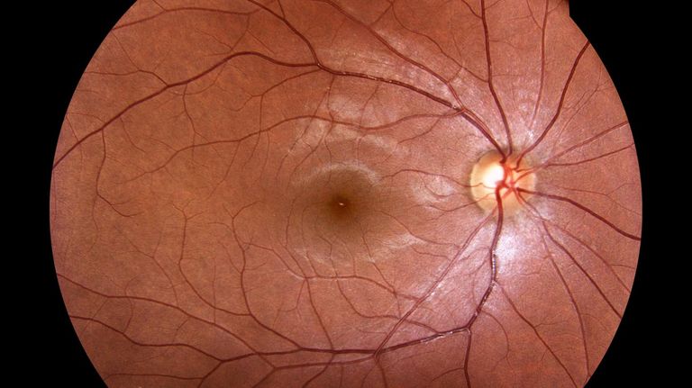 Glaucoma y estudios que oculares 20220310