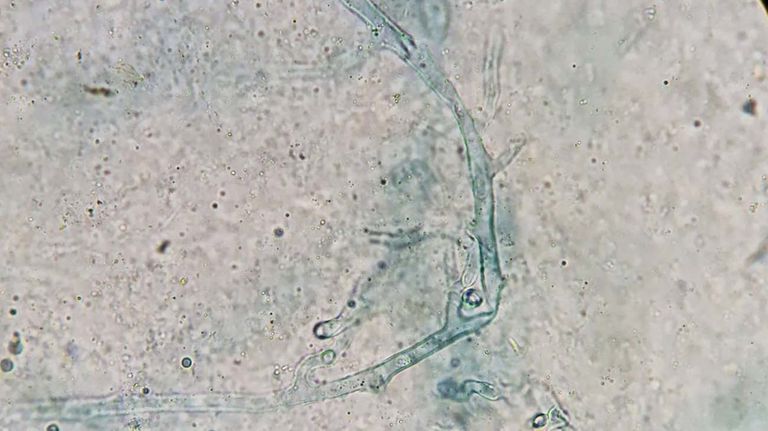 Mucormicosis pulmonar-20210527