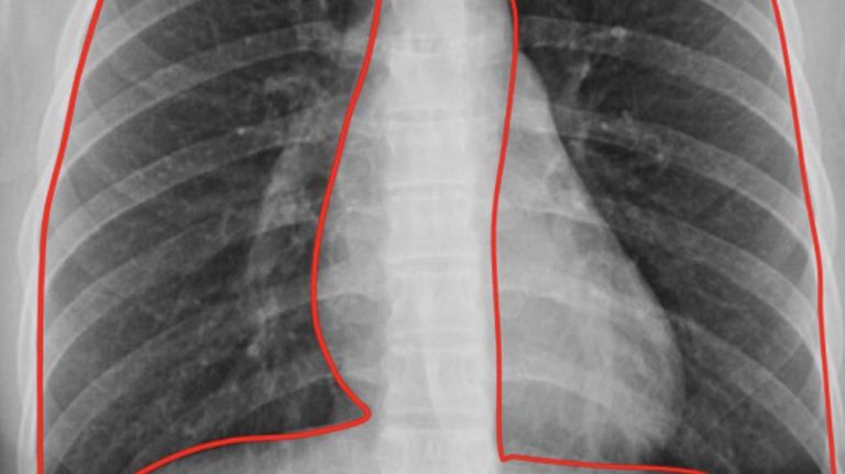 Pulmones 20221230