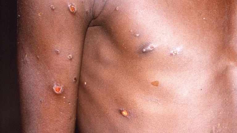 viruela monkeypox