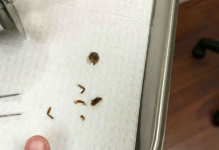 cucaracha en el oido 05122018