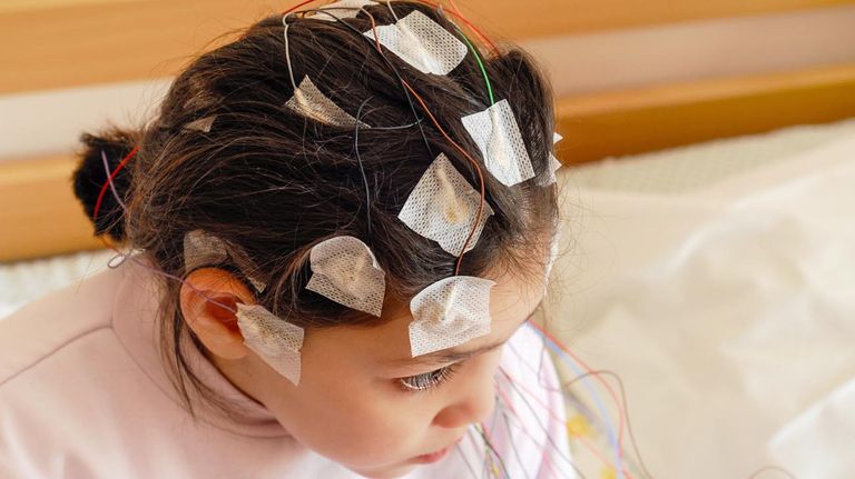 Día mundial de la epilepsia 20220207