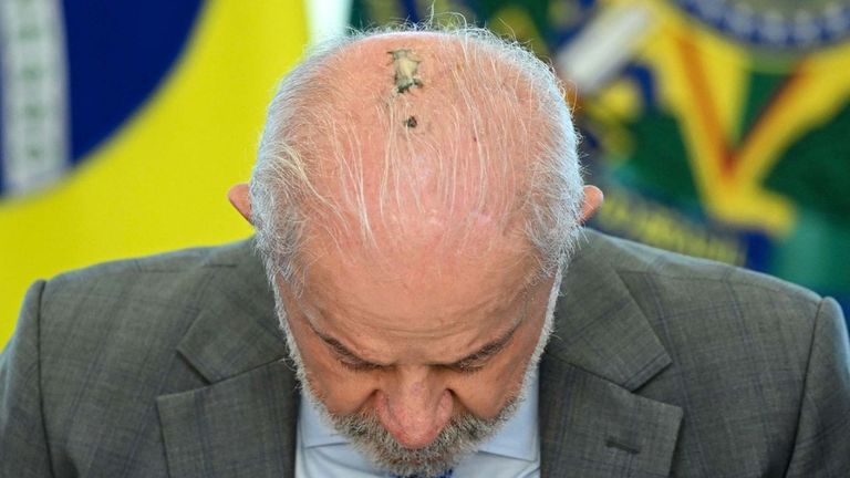 Lula da Silva fue operado el 24 de abril de 2026 por carcinoma basocelular