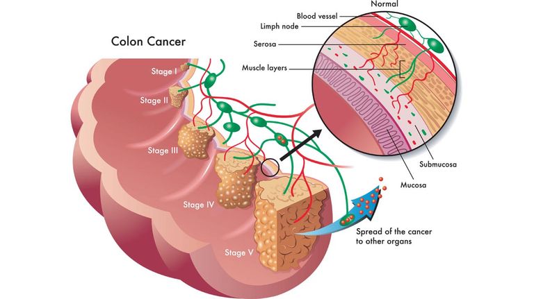 Cancer de Colon 20221111