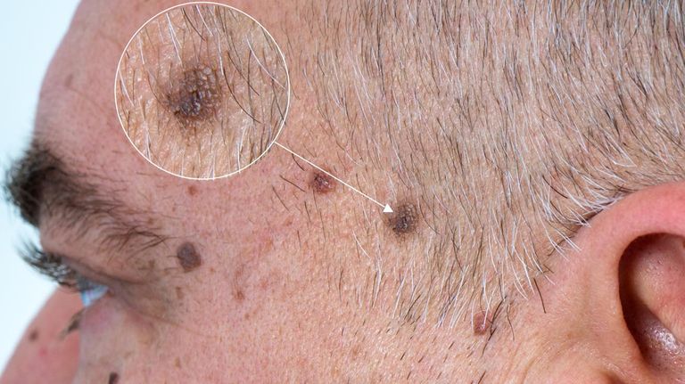 Melanoma