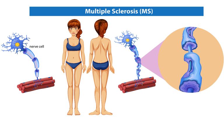 30 de mayo, Día Mundial de la Esclerosis Múltiple