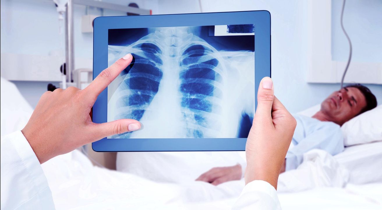 Tuberculosis: cómo se contagia y cuáles son los síntomas