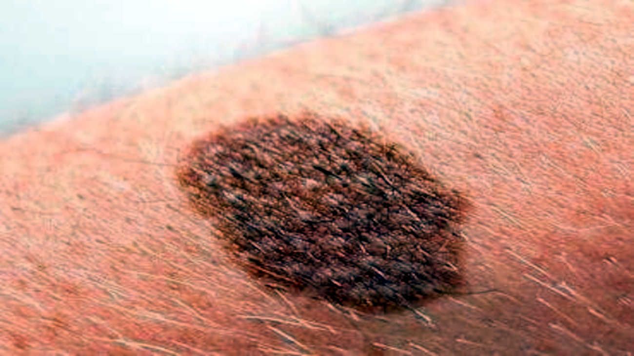 Día Mundial del Melanoma