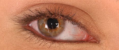 Celulitis orbitaria: ¿Qué es y cómo tratarla?