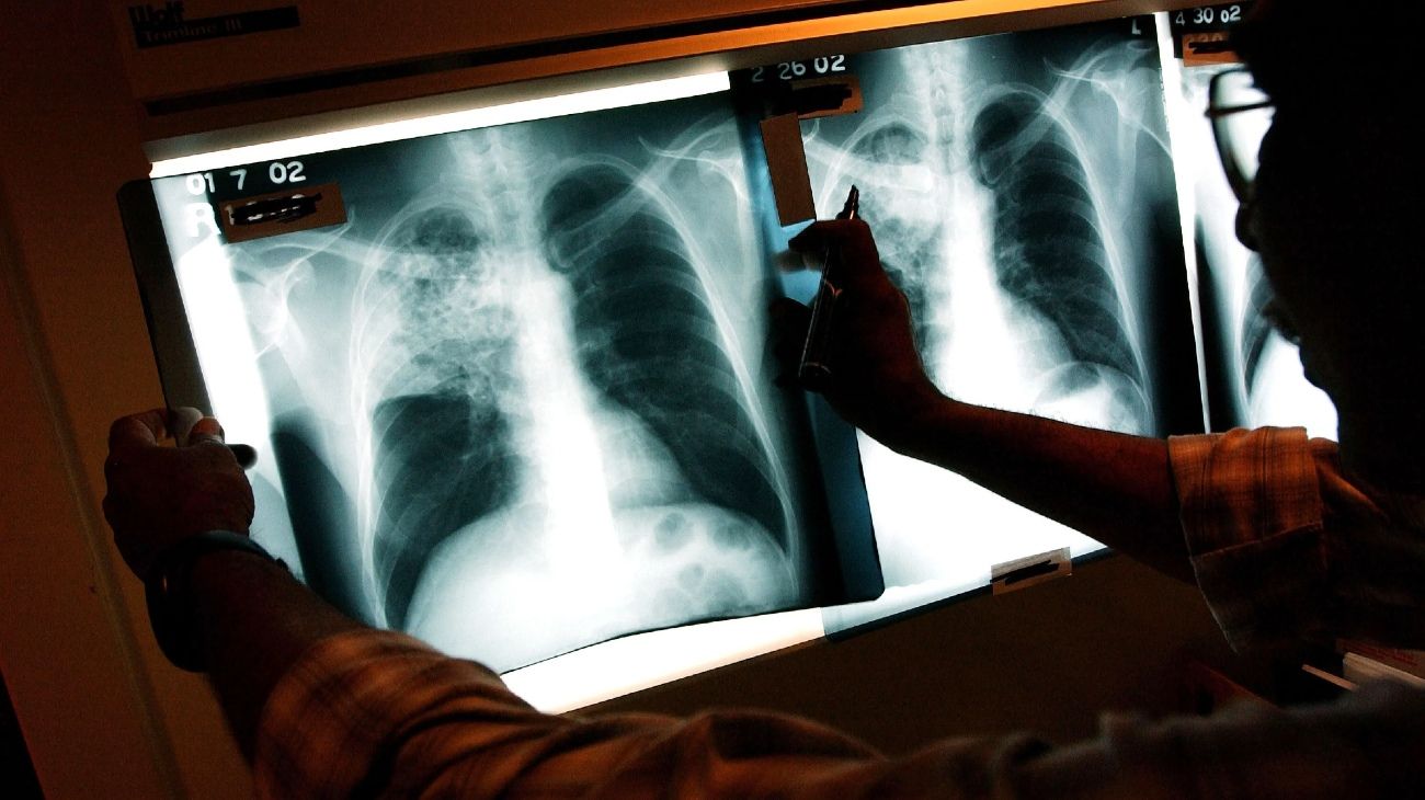 Resolviendo el rompecabezas de la tuberculosis
