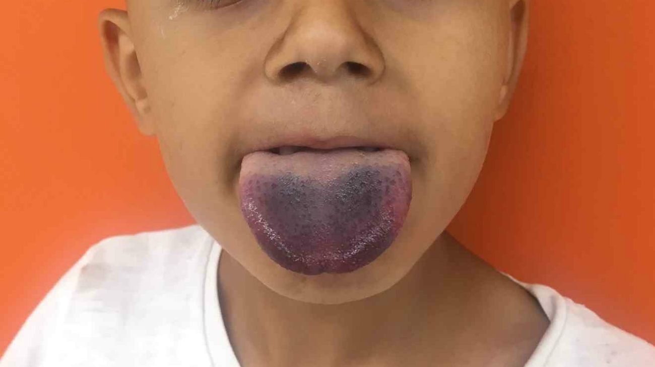 Un médico usó un viejo truco para liberar la lengua de un niño atrapada en una botella