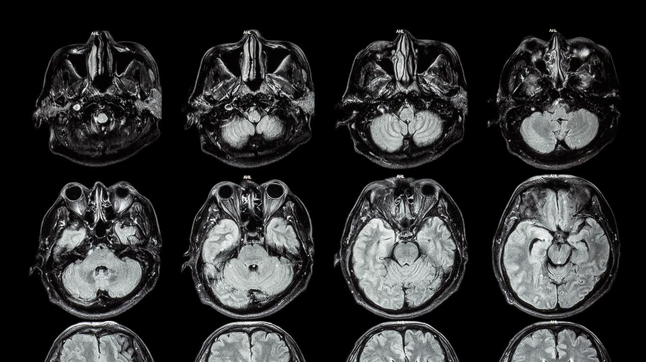 El Covid puede encoger el cerebro de los pacientes