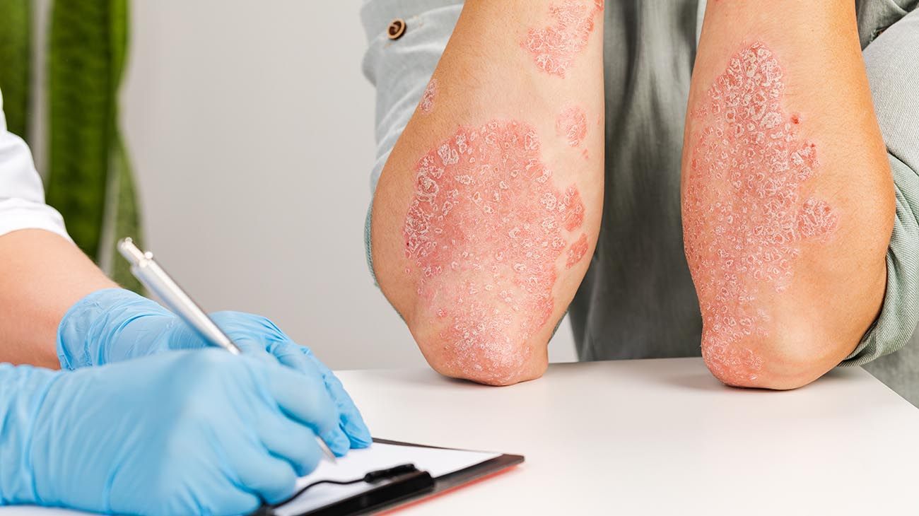 125 millones de personas tienen psoriasis y hay cosas que deben saberse
