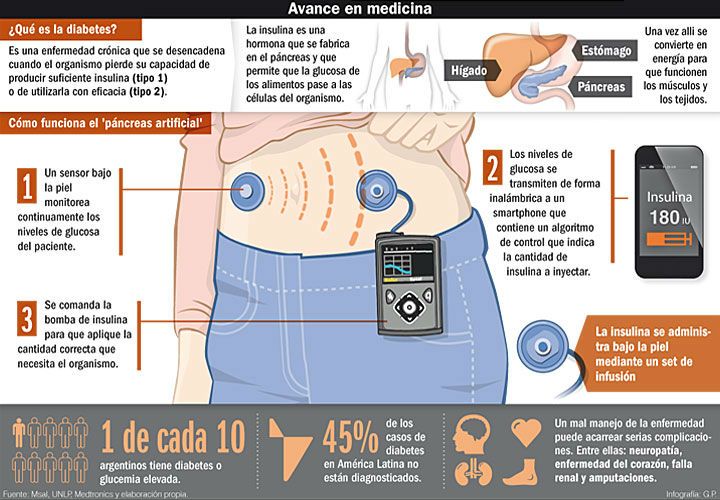 Prueban con éxito un páncreas artificial desarrollado en Argentina