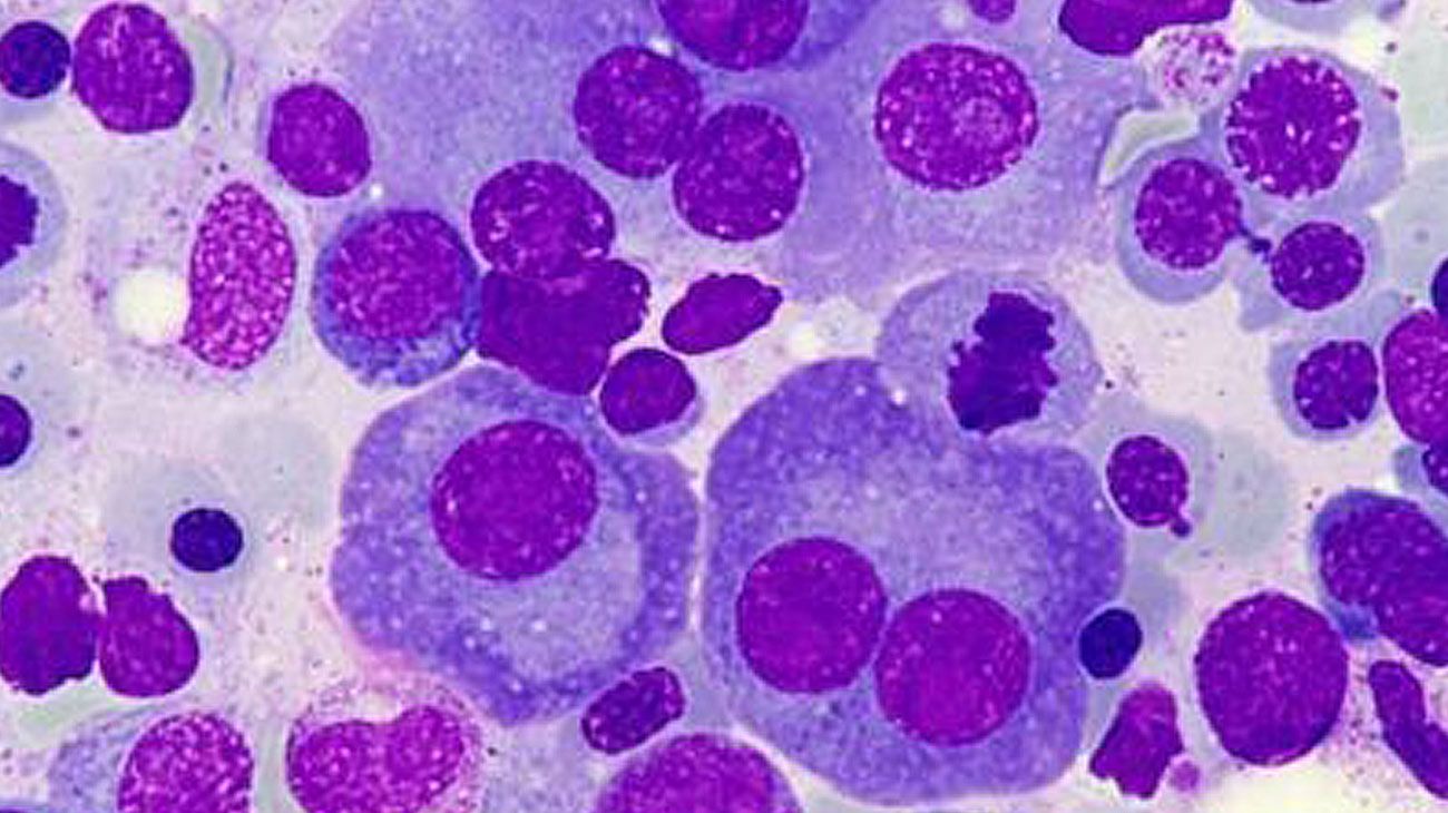Daratumumab: la nueva alternativa aprobada por ANMAT para el cáncer de tipo mieloma múltiple