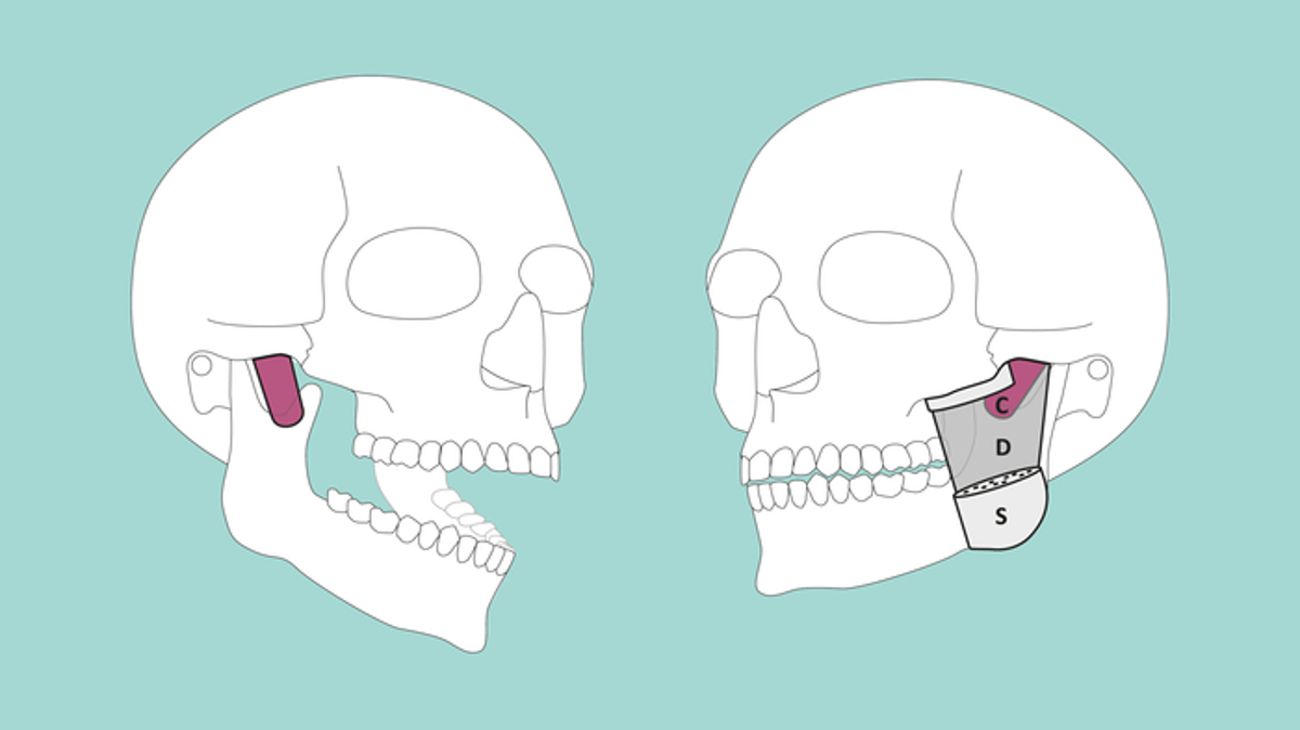 ¿Dónde está el Musculus masseter pars coronidea? Identificaron una nueva parte del cuerpo humano