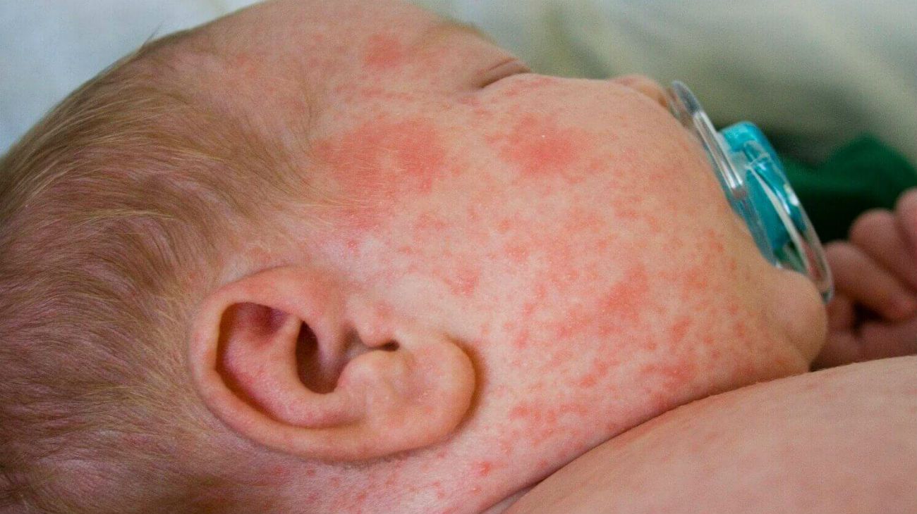 Alerta epidemiológico por dos nuevos casos de sarampión