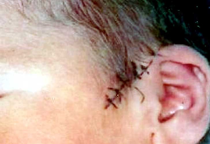 Médicos cortan la cabeza de un bebé durante una cesárea