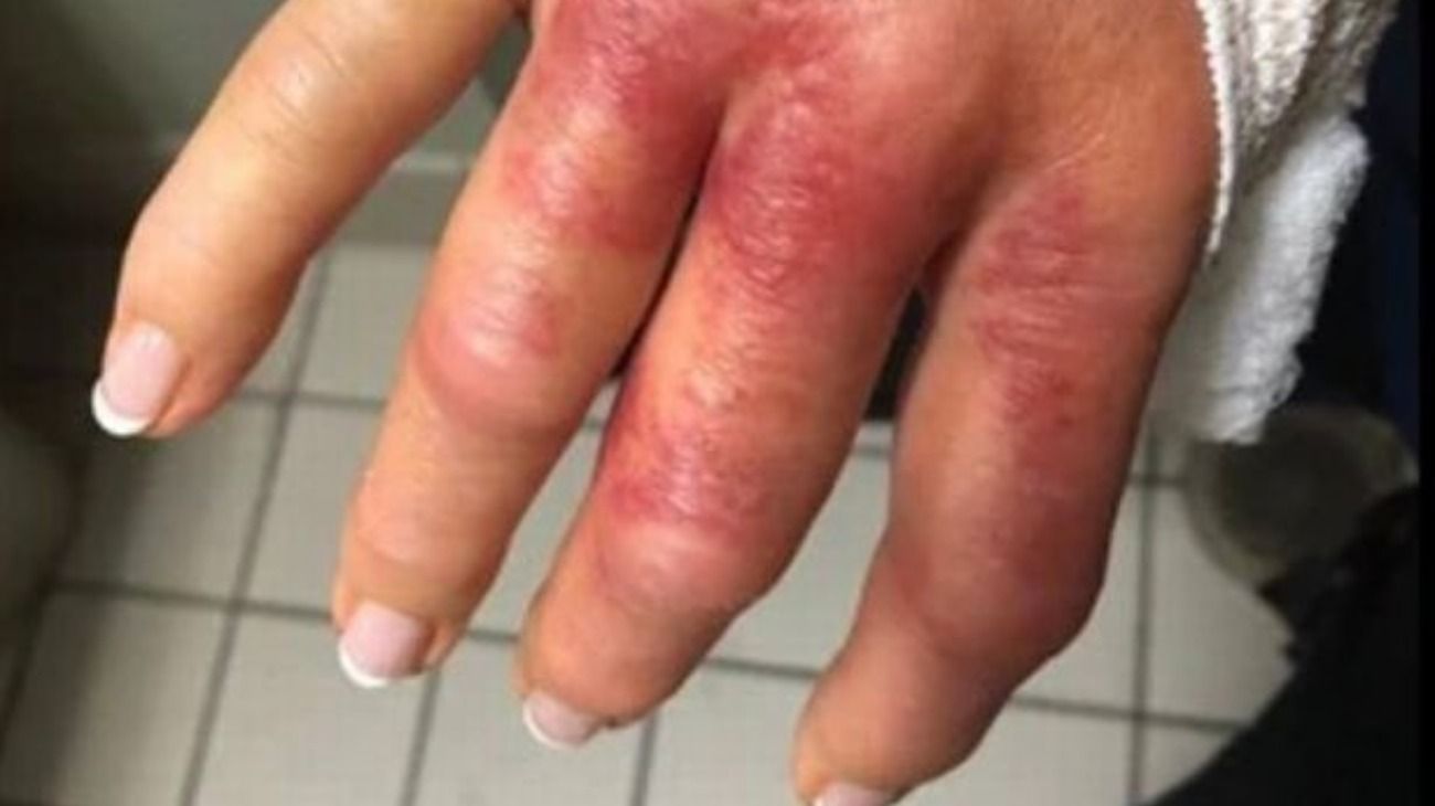 Fue a la manicura, se infectó con una bacteria carnívora y casi pierde el dedo