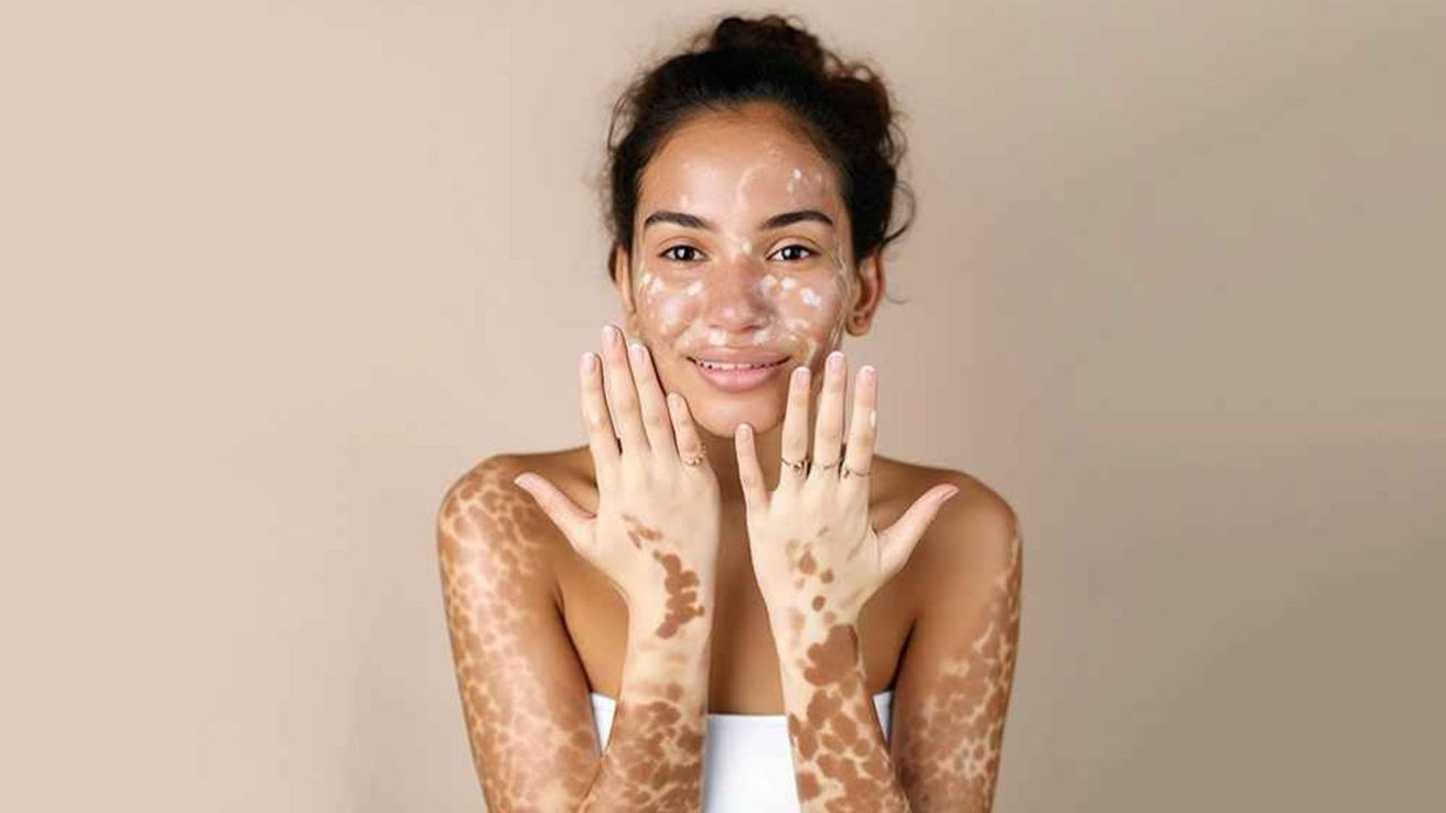 Día mundial del vitiligo: causas, impacto emocional y la necesidad de mayor visibilidad