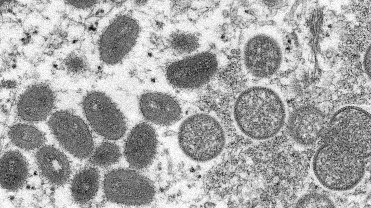 Estados Unidos reportó caso de viruela del mono, el primero en América