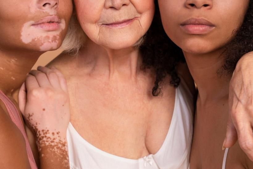 Día Mundial del Vitiligo: el impacto psicológico de una enfermedad que va más allá de la piel
