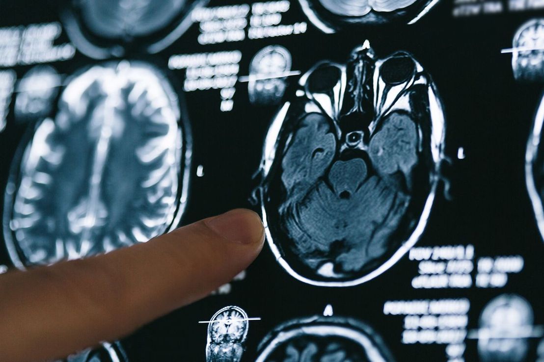 ¿Por qué el cáncer todavía no se puede curar?