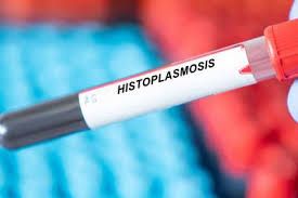 Qué es la histoplasmosis, una enfermedad silenciosa y mortal
