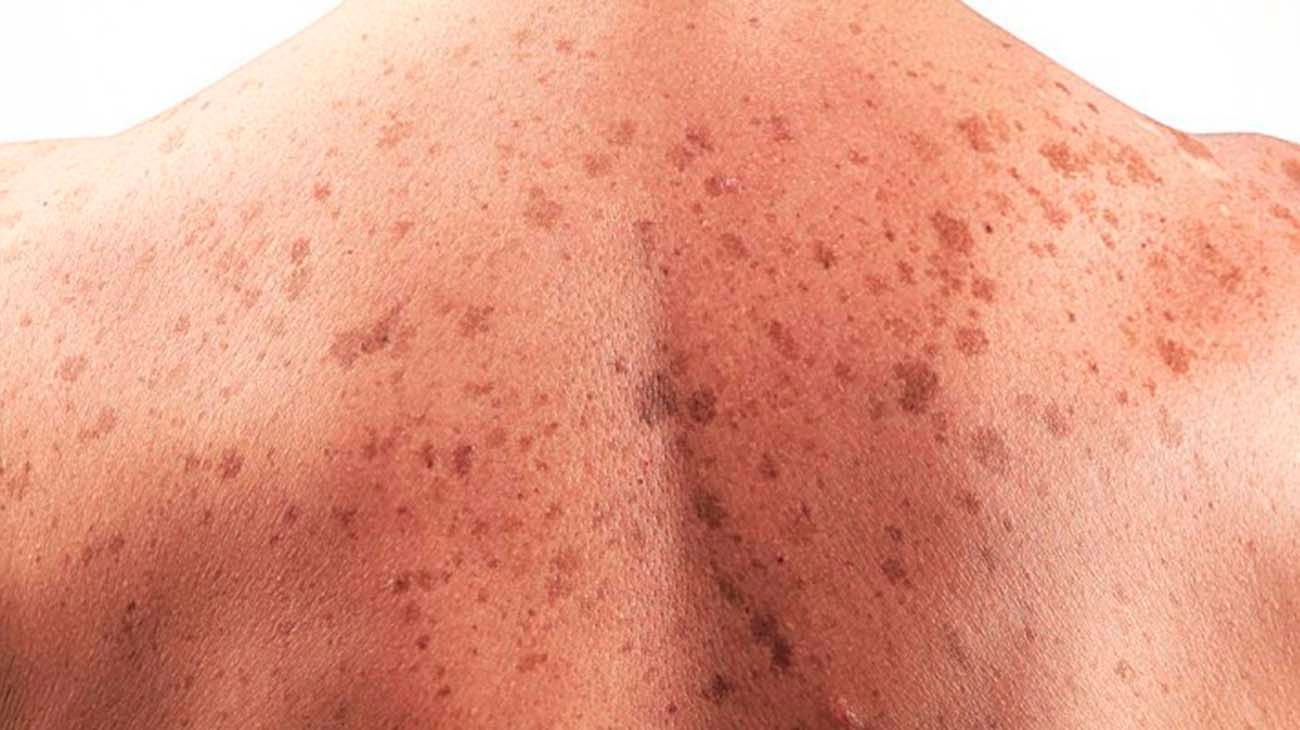 Cómo prevenir el cáncer de piel