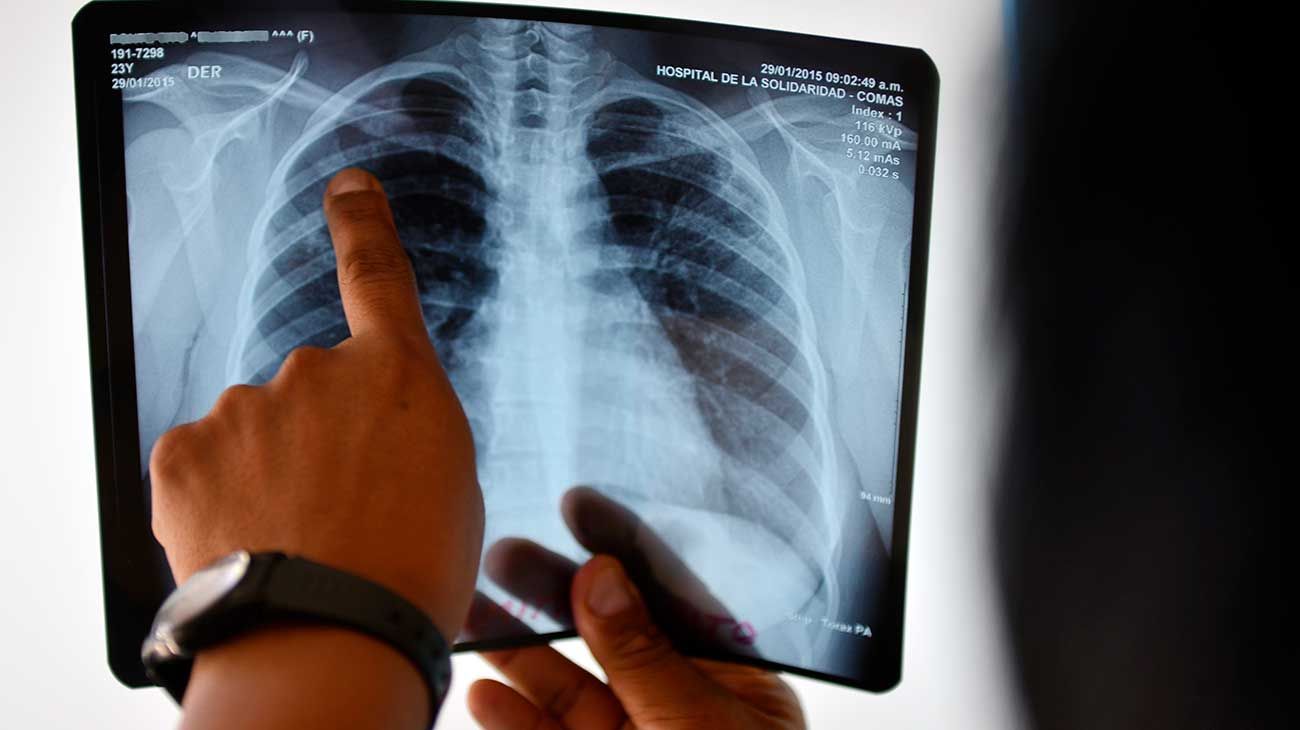 La tuberculosis crece a la par de la pobreza