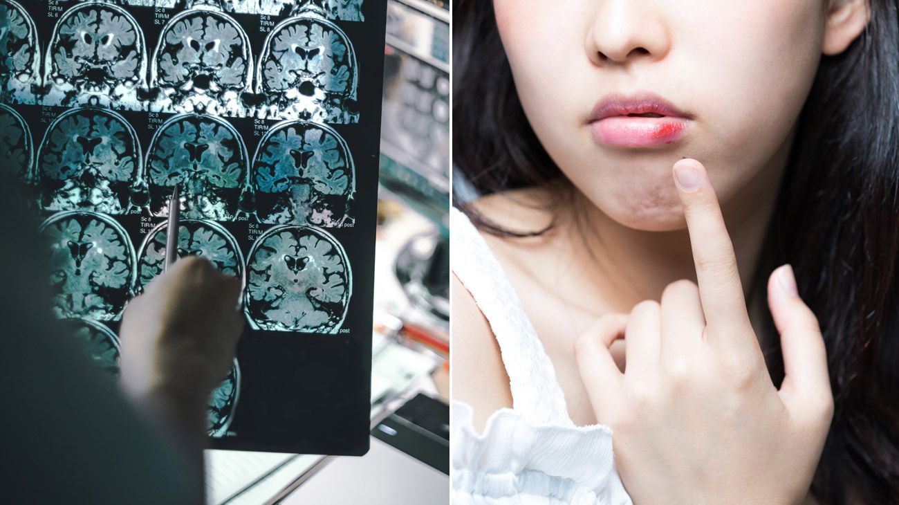 Por qué el virus del herpes labial también podría causar Alzheimer
