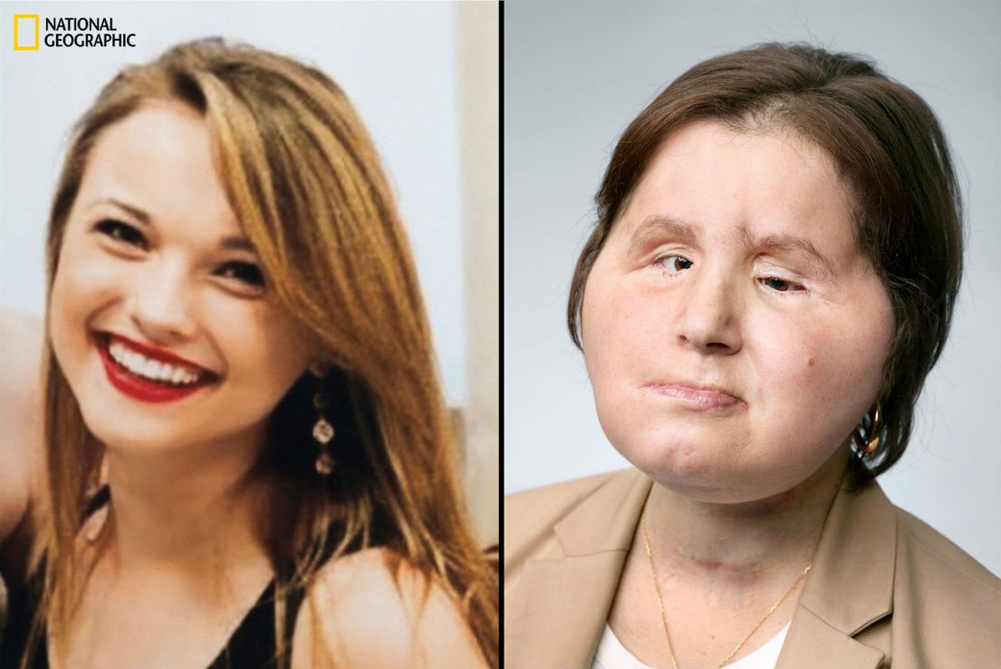 La historia de Katie, la mujer más joven en recibir un trasplante de cara