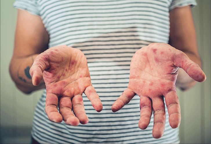 Salud en crisis: hubo una muerte por sarampión y otra por dengue