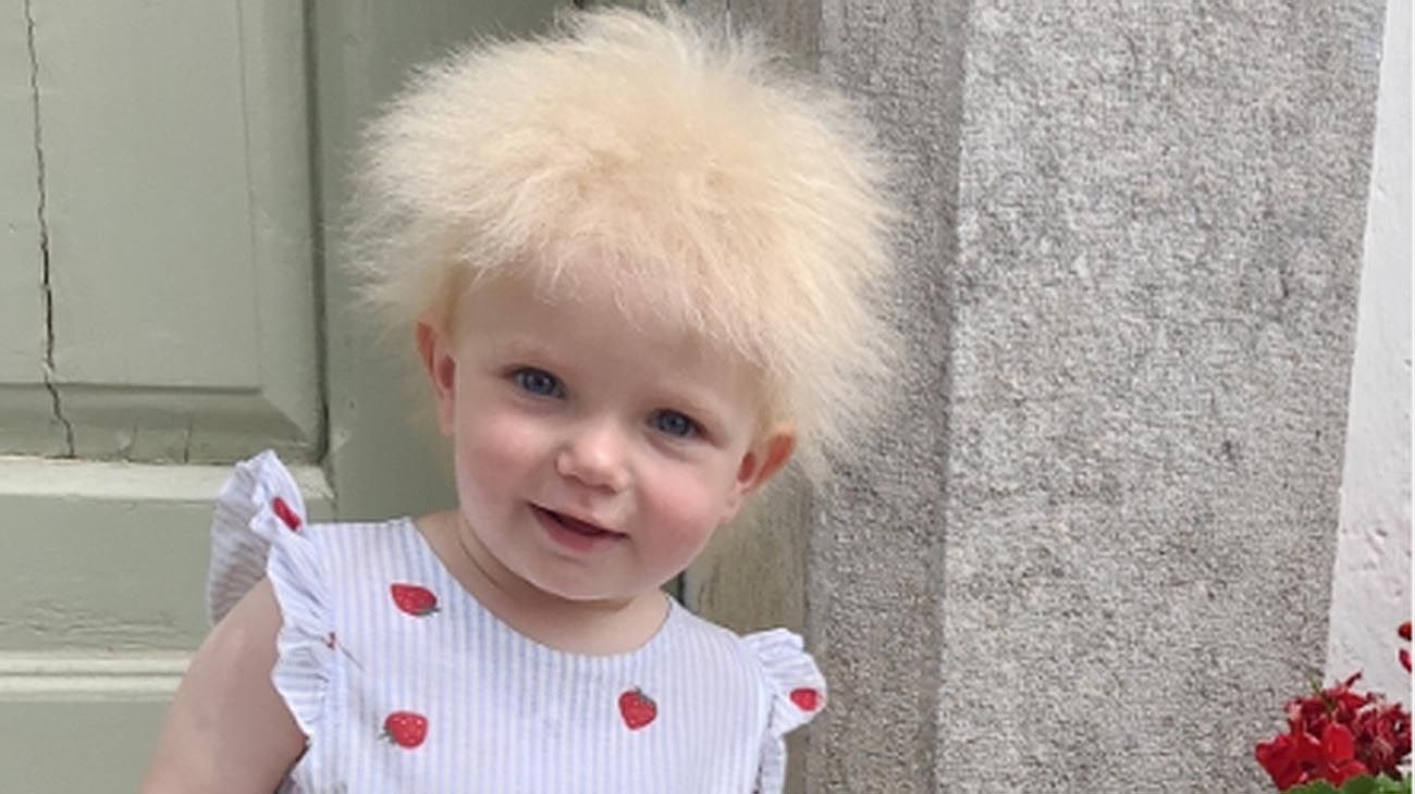 Layla, de 17 meses, tiene el raro síndrome de cabello impeinable: solo hay 100 casos en el mundo