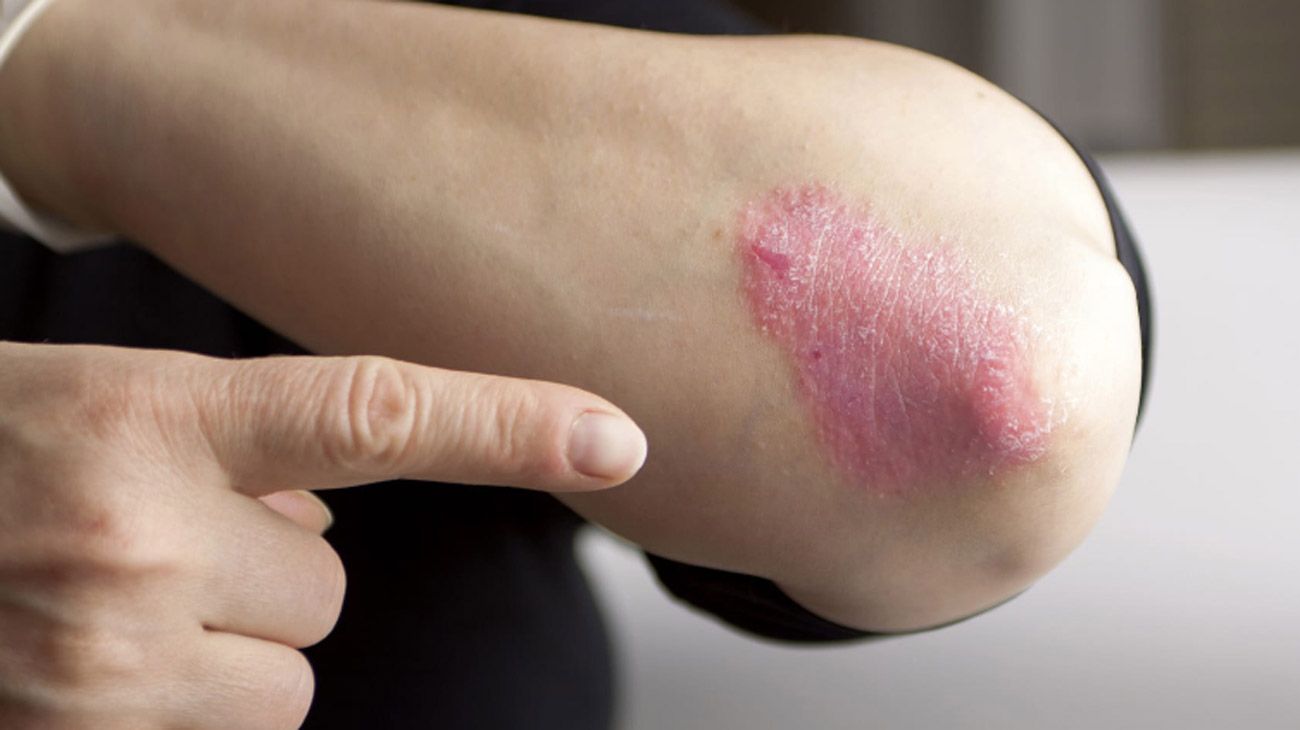 Qué es la psoriasis y cuál es su tratamiento