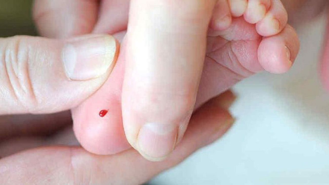 La Atrofia Muscular, más cerca de incluirse en la Pesquisa Neonatal