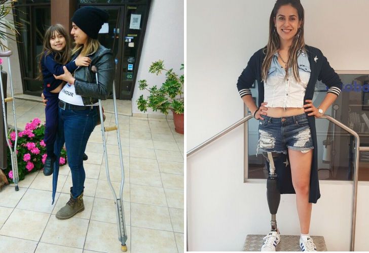 La joven madre soltera que conmovió al país consiguió su pierna ortopédica
