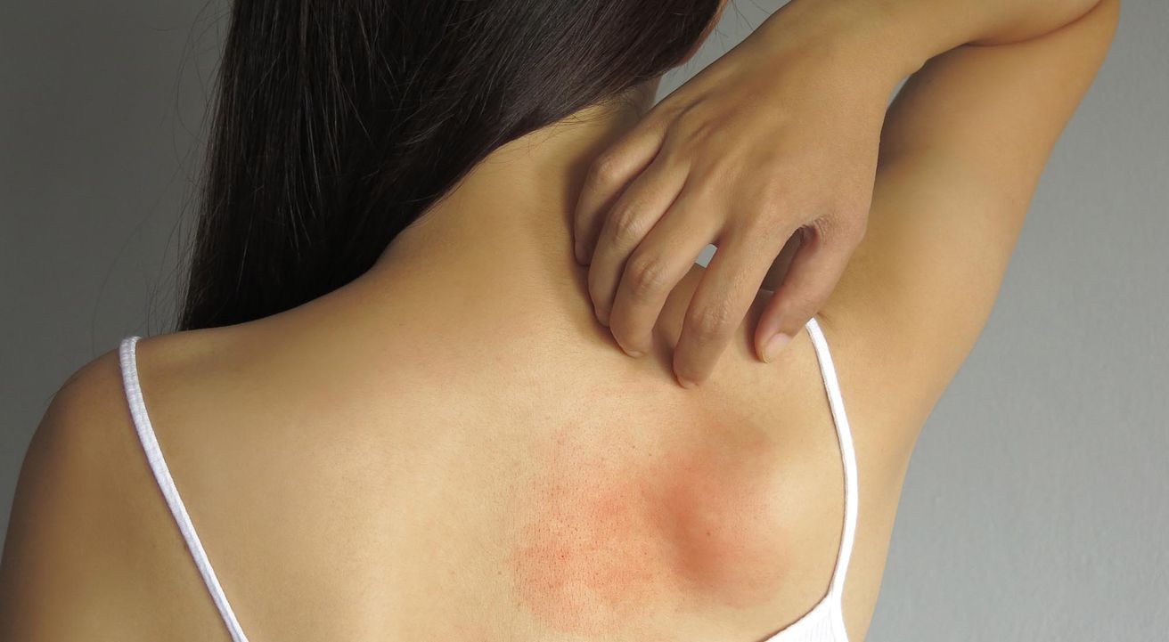 Día mundial de la psoriasis, qué es y cómo tratar esta enfermedad