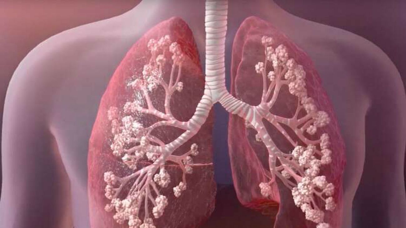 Qué es la fibrosis quística