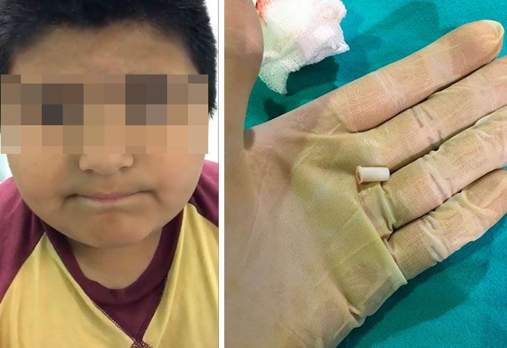 Nene tucumano se tragó un silbato y su voz se volvió viral