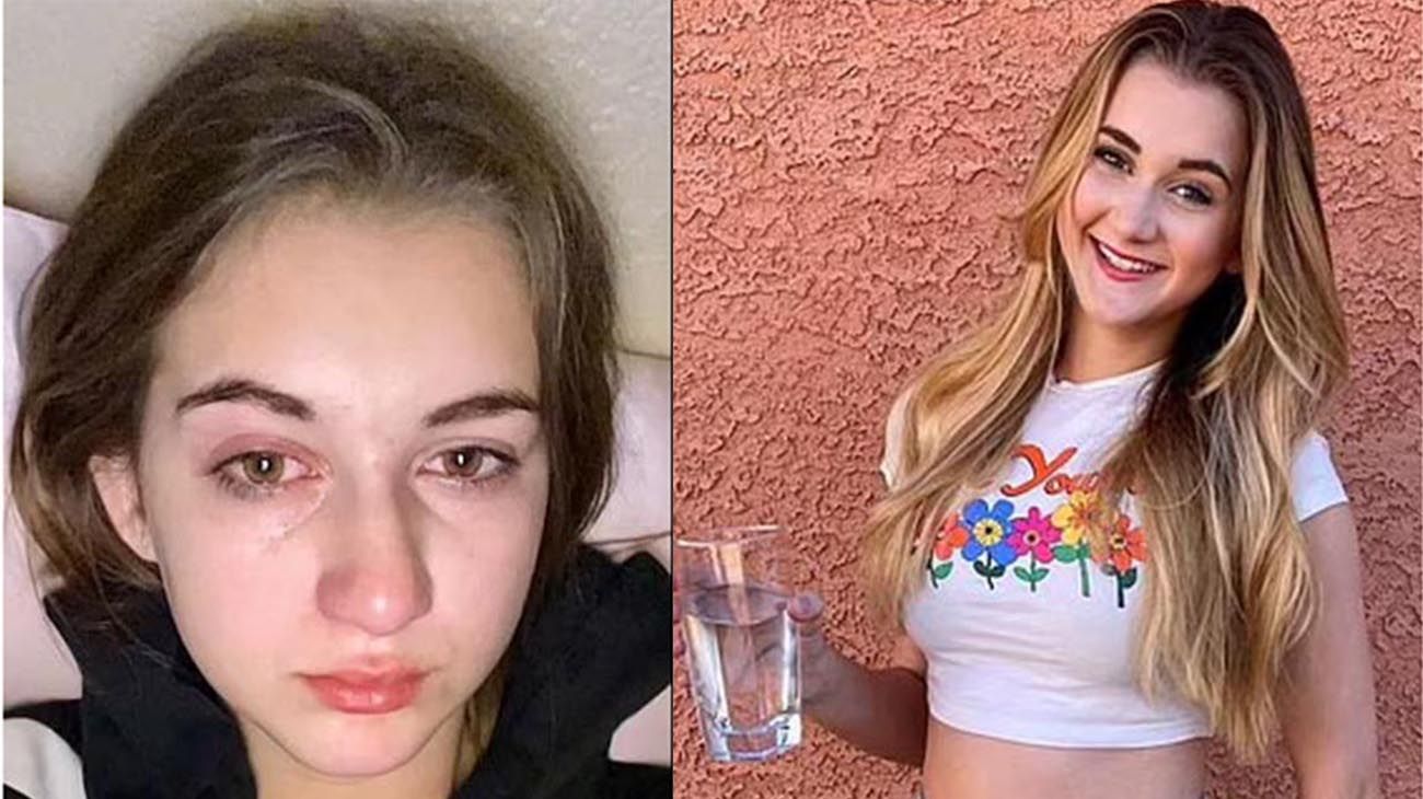 El extraño caso de la joven alérgica al agua: sus propias lágrimas le dañan la piel