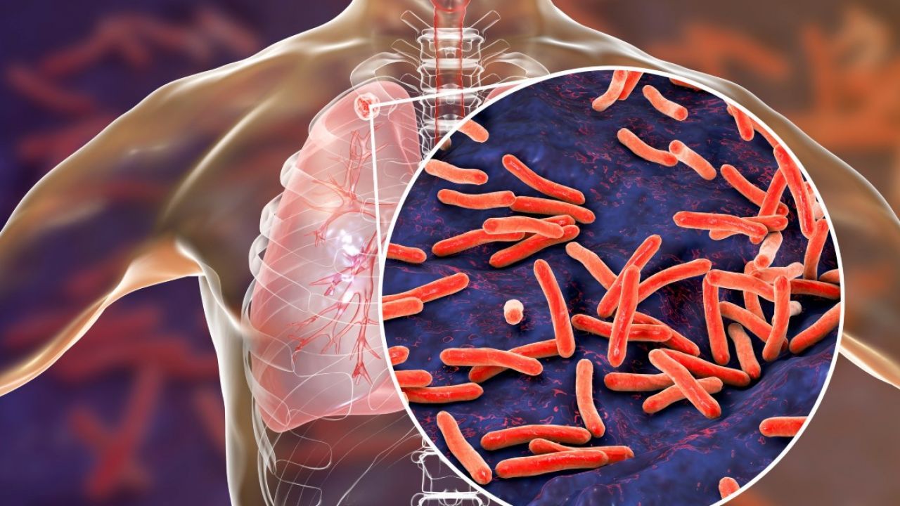 La OMS advierte sobre un aumento de casos de tuberculosis en varios países
