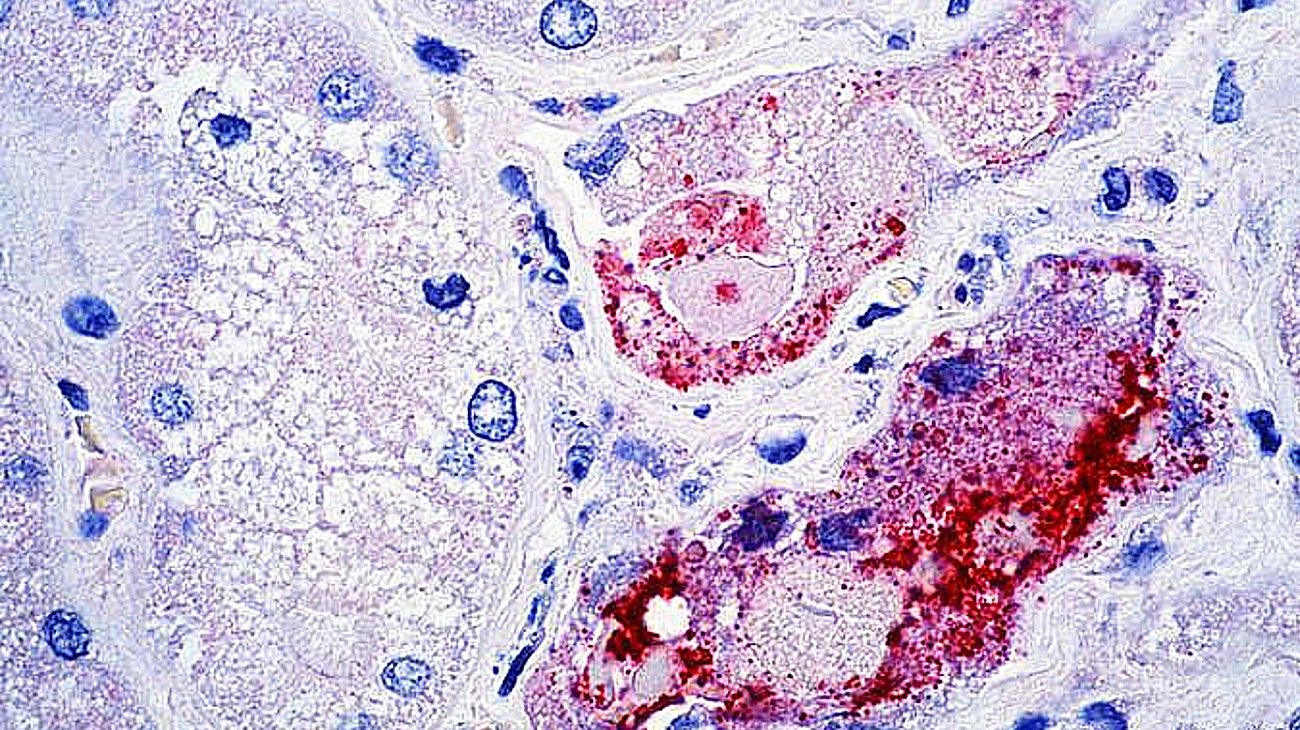 Alarma en India: el letal virus Nipah, proveniente de murciélagos, mató a un niño de 12 años