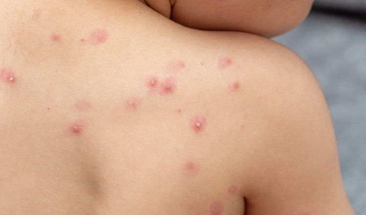 Confirman el primer caso de una persona infectada por una variante más contagiosa y severa de viruela del mono