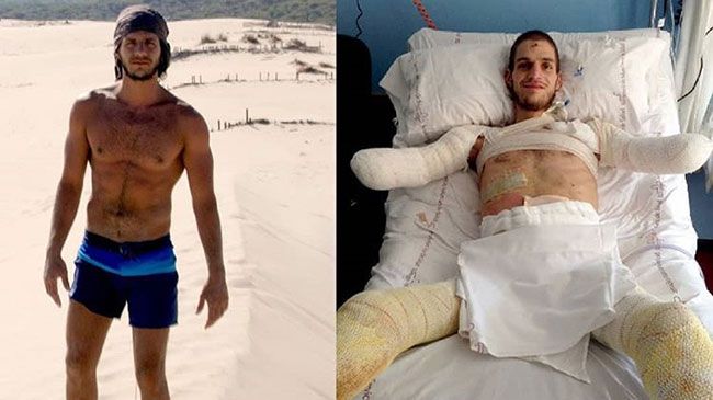 Por un diagnóstico erróneo, a un joven debieron amputarle brazos y piernas
